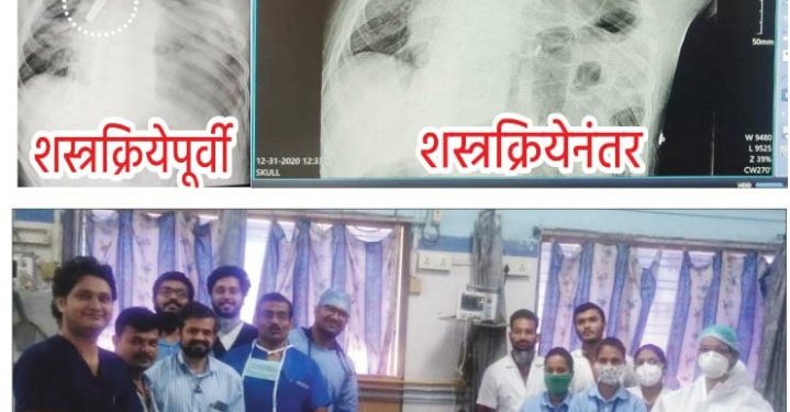 डॉ. उल्हास पाटील रुग्णालयात ‘ गुलियन-बार्रे सिंड्रोम’ या आजारावर यशस्वी शस्त्रक्रिया