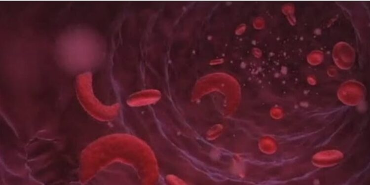 सिकलसेल ‘या’ गंभीर आजारा विषयी तुम्हाला हे माहित आहे का ?