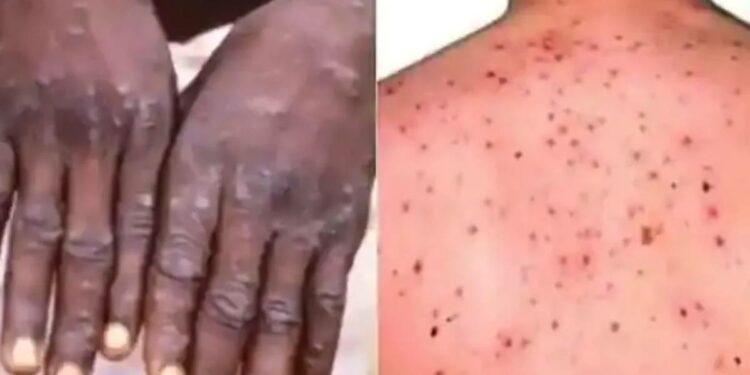 कोरोनानंतर आता ‘या’ विषाणूने वाढवले जगाचे टेन्शन