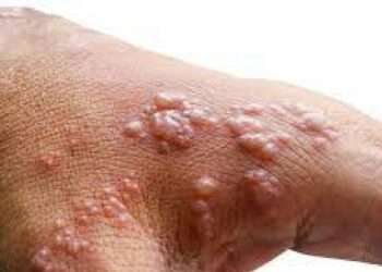 लैंगिक गैरवर्तन, मिठी मारण्यासह आता चुंबनावरही बंधने ; मंकीपॉक्सबाबत मार्गदर्शक तत्त्वे जारी