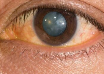 अत्यल्प दरात मोतीबिंदू शस्त्रक्रिया शिबिर ; उशीर कशाला ?…आजच नाव नोंदणी करा