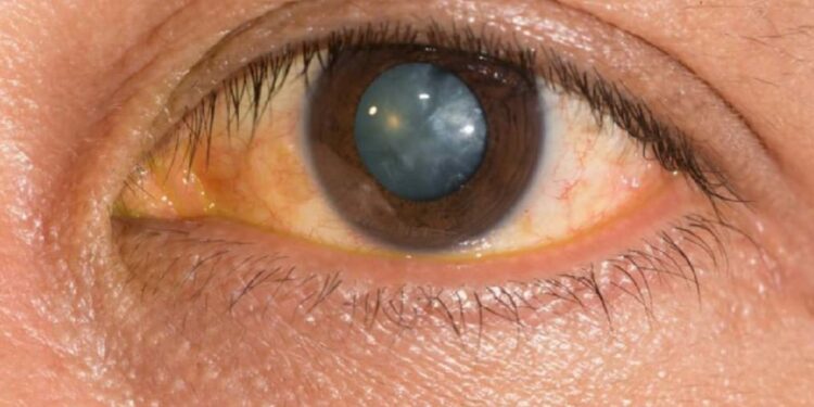 अत्यल्प दरात मोतीबिंदू शस्त्रक्रिया शिबिर ; उशीर कशाला ?…आजच नाव नोंदणी करा