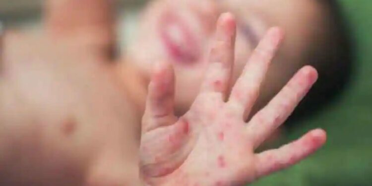 मुलांमध्ये हा आजाराचा झपाट्याने पसरतोय.. संसर्ग घातक असू शकतो ; जाणून घ्या काय आहेत लक्षणे