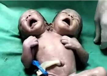 शरीर एकच, पण, दोन डोकं, दोन हात-पाय ; जळगावत शरीराने जुळलेल्या मुलींचा जन्म