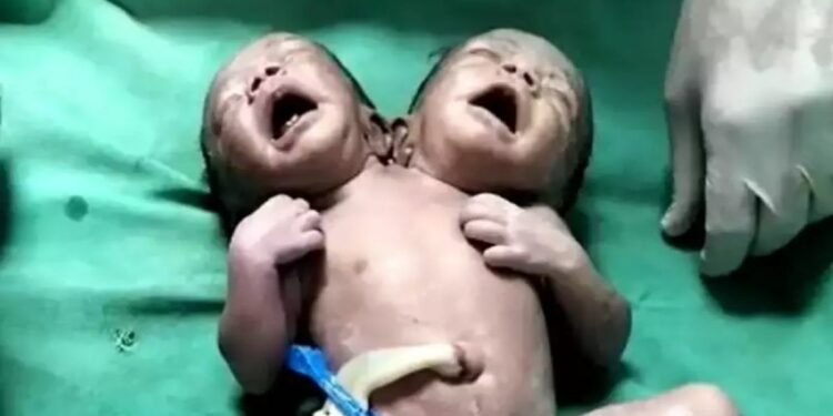 शरीर एकच, पण, दोन डोकं, दोन हात-पाय ; जळगावत शरीराने जुळलेल्या मुलींचा जन्म