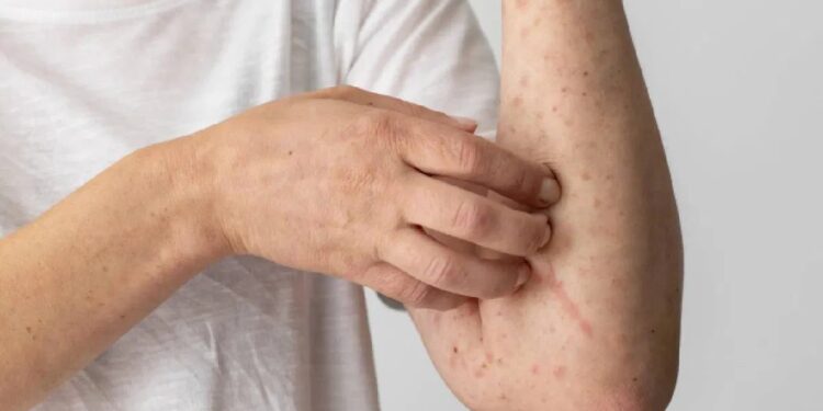 त्वचेवर खाज येणे हे ‘या’ धोकादायक आजाराचे लक्षण, त्वरित उपचार करा