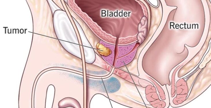पुरुषांचे आयुष्य उद्ध्वस्त करणाऱ्या ‘Prostate Cancer’ ची सुरूवातीची 5 लक्षणे कोणती?