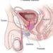 पुरुषांचे आयुष्य उद्ध्वस्त करणाऱ्या ‘Prostate Cancer’ ची सुरूवातीची 5 लक्षणे कोणती?