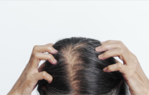 Telogen Effluvium hair loss कारणे आणि उपाय मराठीत