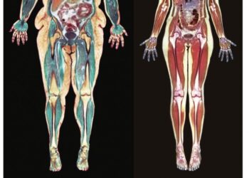 स्थूलता आणि शरीरावर होणारे परिणाम