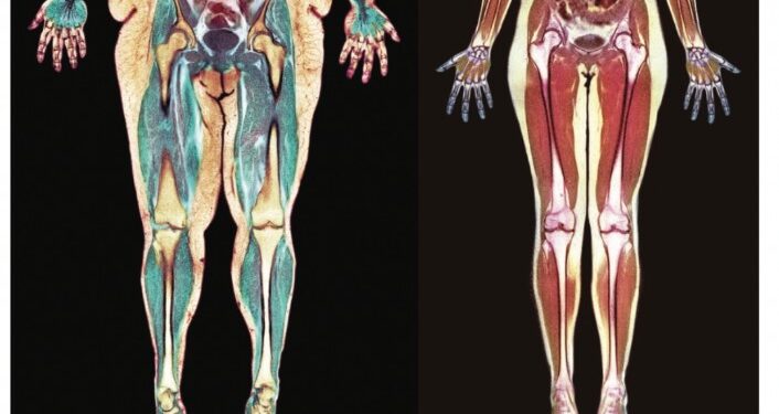 स्थूलता आणि शरीरावर होणारे परिणाम