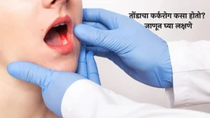 Mouth Cancer Symptoms