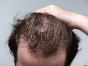 Telogen Effluvium hair loss कारणे आणि उपाय मराठीत