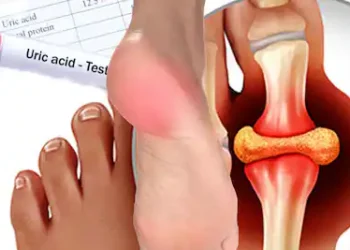 Foods to Reduce Uric Acid