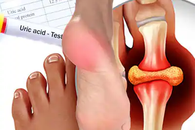 Foods to Reduce Uric Acid